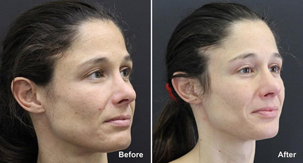 Patient 718, Rhinoplasty Before and After Photos Rhinoplasty Before and After Photos in Princeton, NJ, Patient 718