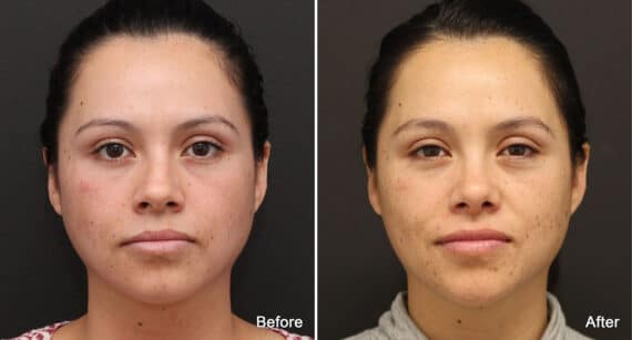 Rhinoplasty Before and After Photos in Princeton, NJ, Patient 730