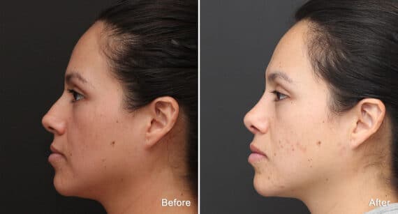 Rhinoplasty Before and After Photos in Princeton, NJ, Patient 730