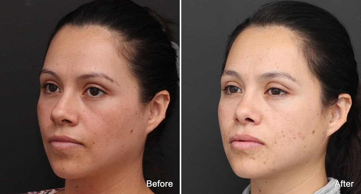 Rhinoplasty Before and After Photos in Princeton, NJ, Patient 730