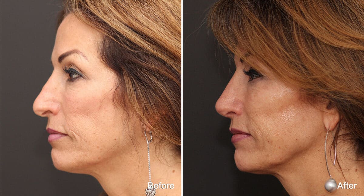 Rhinoplasty Before and After Photos in Princeton, NJ, Patient 740