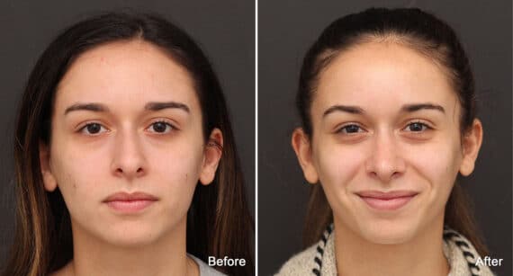 Rhinoplasty Before and After Photos in Princeton, NJ, Patient 750