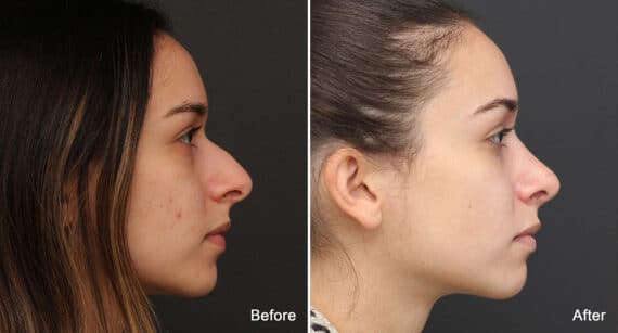 Rhinoplasty Before and After Photos in Princeton, NJ, Patient 750