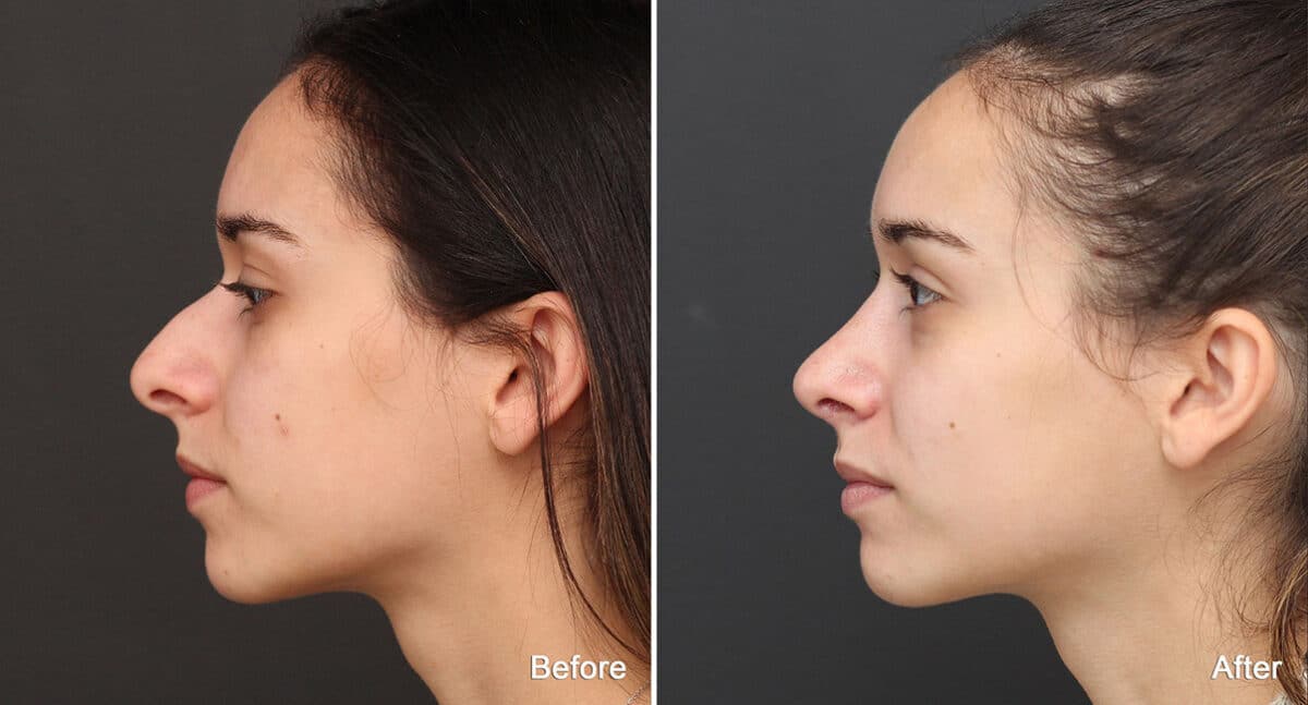Rhinoplasty Before and After Photos in Princeton, NJ, Patient 750