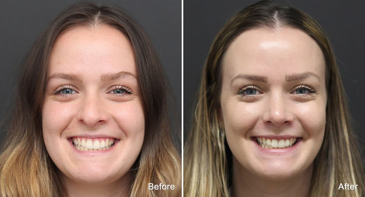 Rhinoplasty Before and After Photos in Princeton, NJ, Patient 773