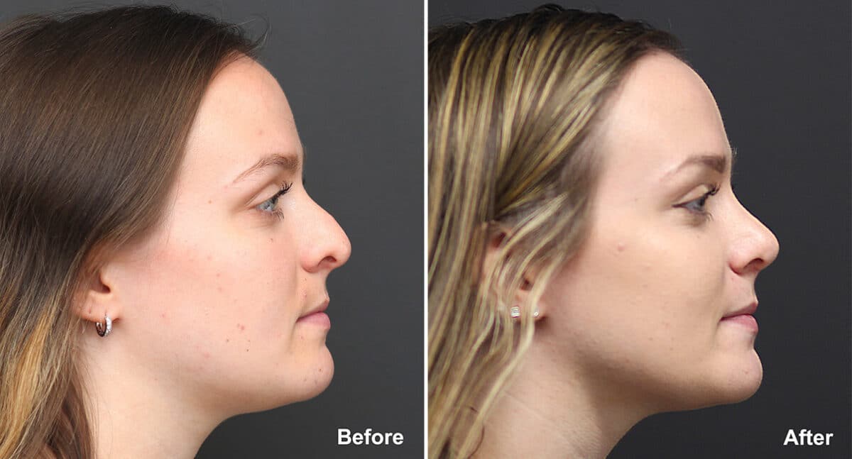 Rhinoplasty Before and After Photos in Princeton, NJ, Patient 773