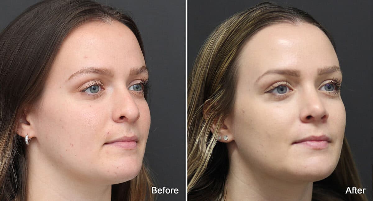 Rhinoplasty Before and After Photos in Princeton, NJ, Patient 773