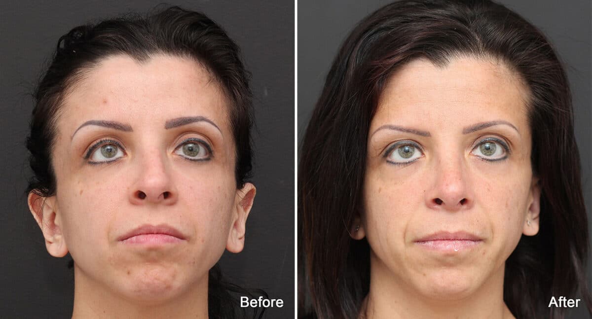 Rhinoplasty Before and After Photos in Princeton, NJ, Patient 783