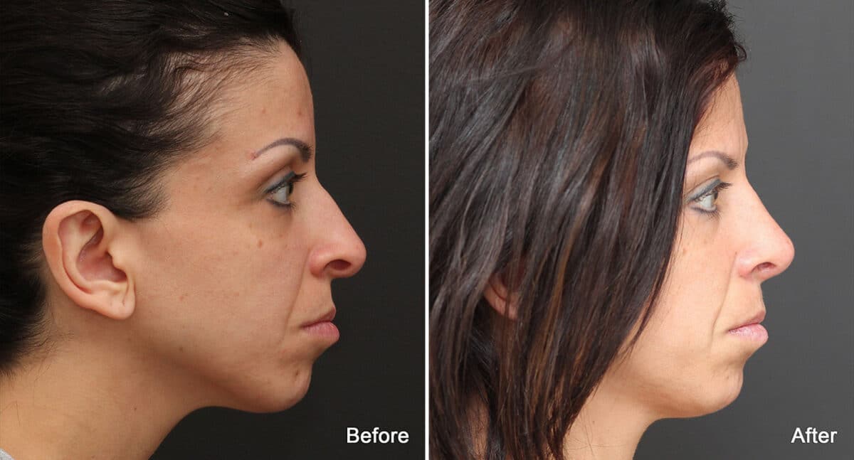 Rhinoplasty Before and After Photos in Princeton, NJ, Patient 783