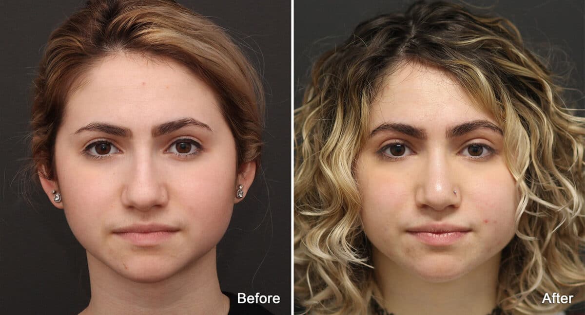 Rhinoplasty Before and After Photos in Princeton, NJ, Patient 790