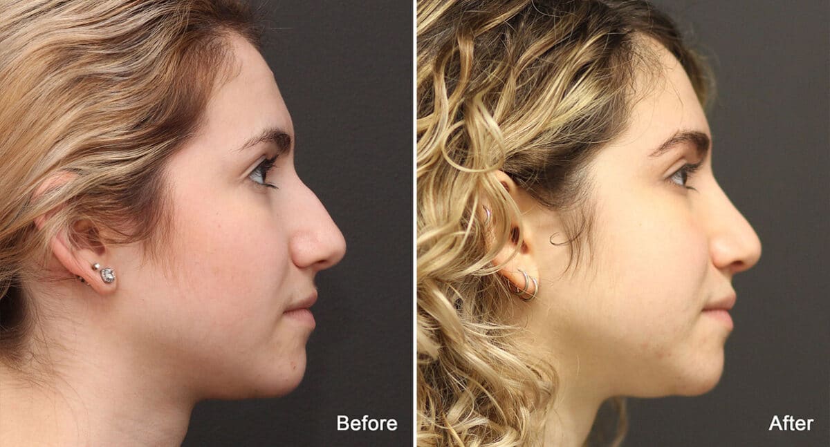 Rhinoplasty Before and After Photos in Princeton, NJ, Patient 790