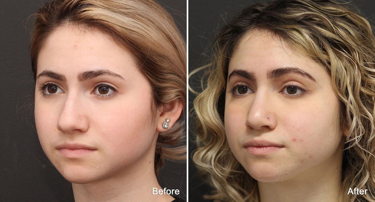 Rhinoplasty Before and After Photos in Princeton, NJ, Patient 790