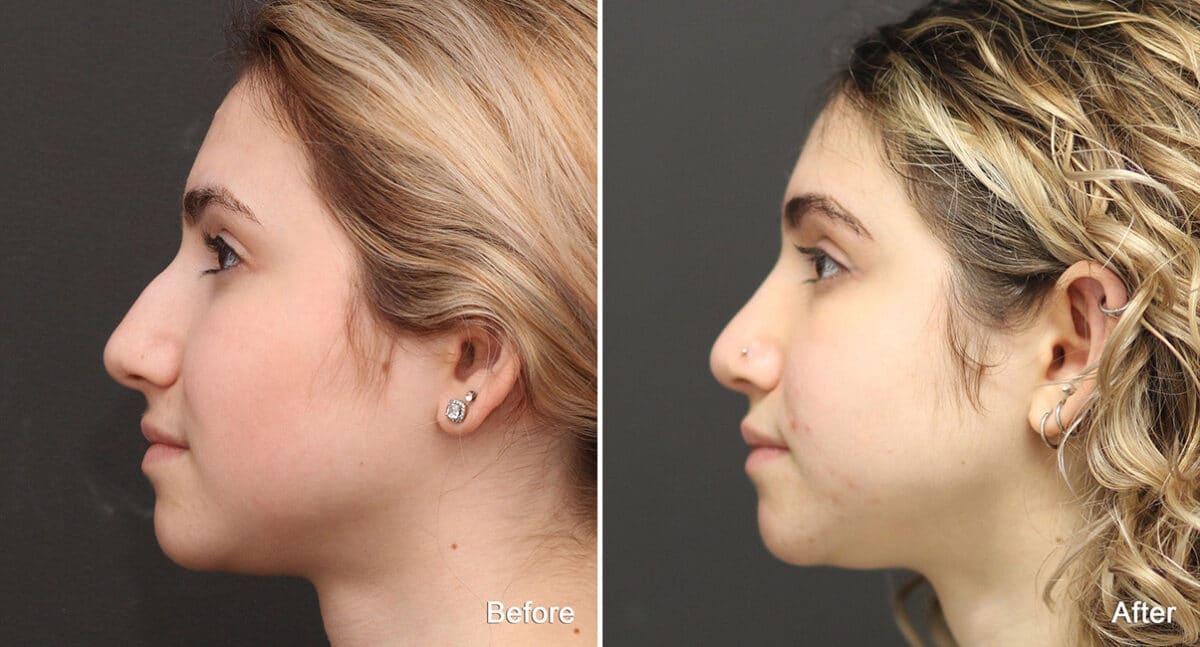 Rhinoplasty Before and After Photos in Princeton, NJ, Patient 790