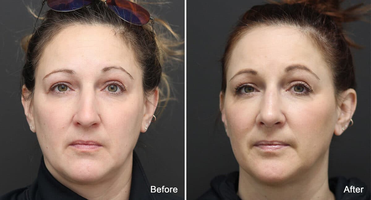 Rhinoplasty Before and After Photos in Princeton, NJ, Patient 803