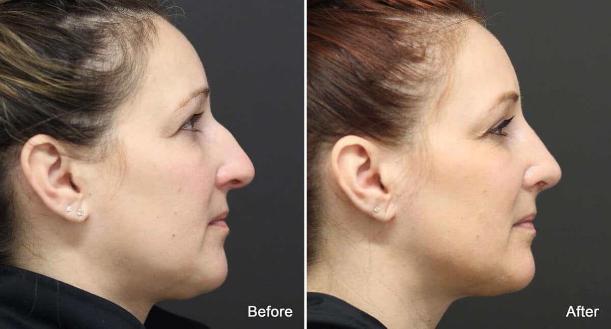 Rhinoplasty Before and After Photos in Princeton, NJ, Patient 803