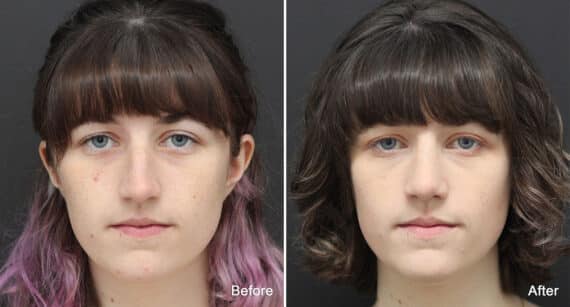 Rhinoplasty Before and After Photos in Princeton, NJ, Patient 810