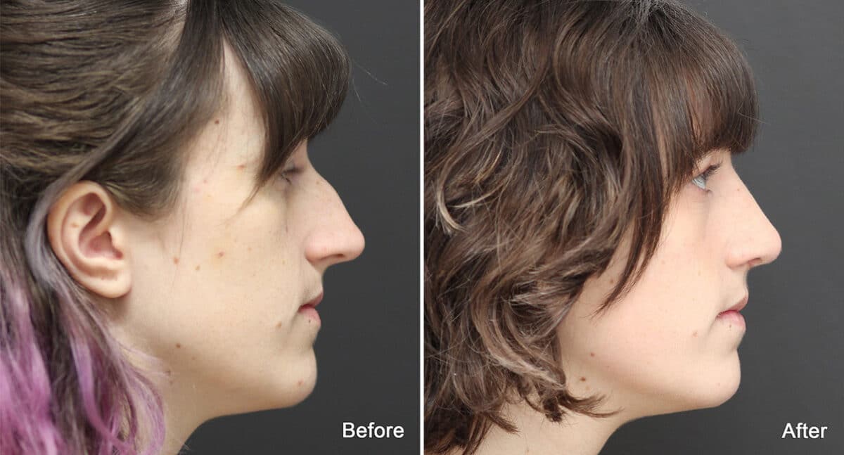 Rhinoplasty Before and After Photos in Princeton, NJ, Patient 810