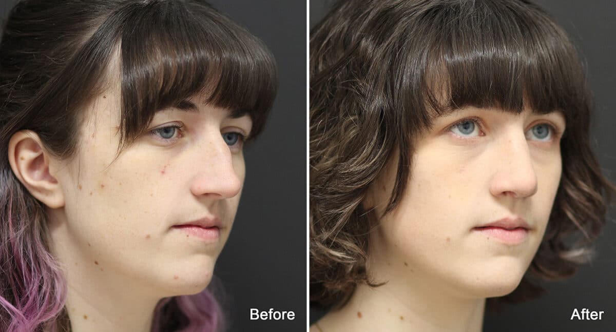 Rhinoplasty Before and After Photos in Princeton, NJ, Patient 810