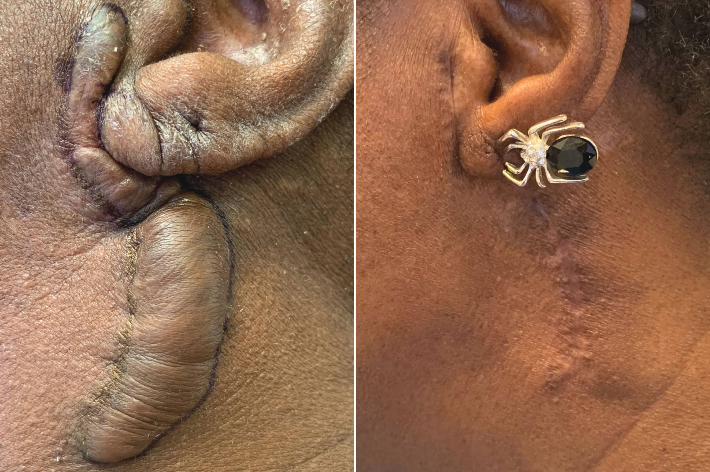 Before and after scar revision results showing smoother, less noticeable neck scarring.