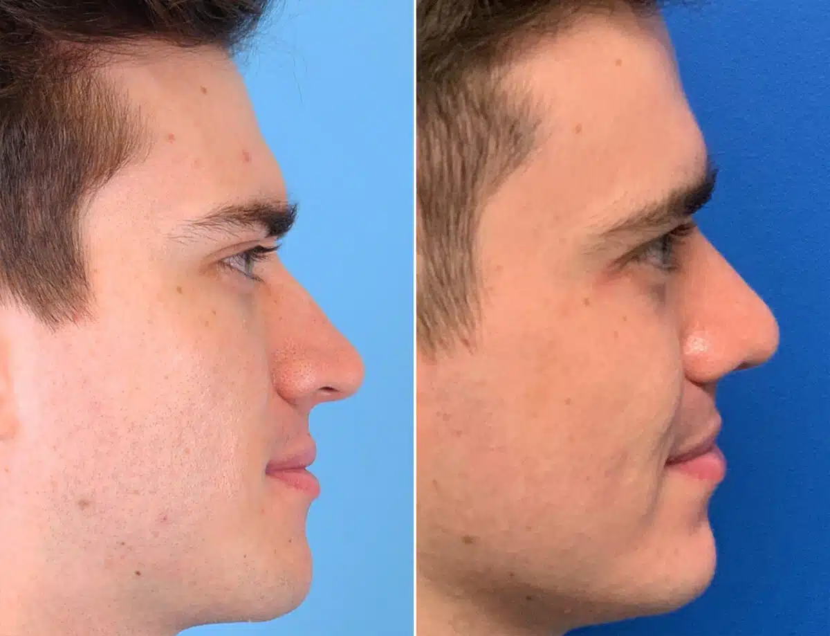 Twisted Nose Before and After Photos in Sewell, NJ, Patient 1611