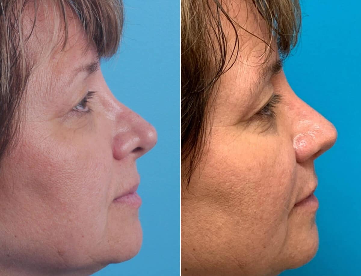 Twisted Nose Before and After Photos in Sewell, NJ, Patient 1644