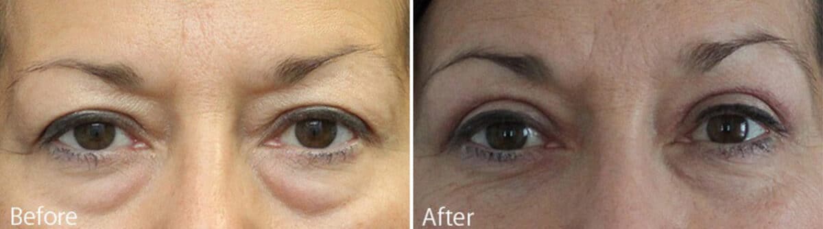 Upper and Lower Eyelid Surgery Before and After Photos in Princeton, NJ, Patient 911