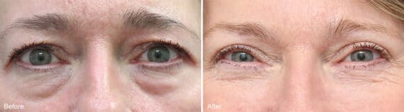 Upper and Lower Eyelid Surgery Before and After Photos in Princeton, NJ, Patient 946