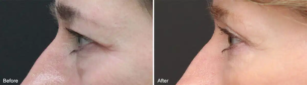 Upper and Lower Eyelid Surgery Before and After Photos in Princeton, NJ, Patient 946