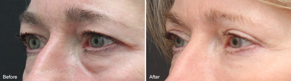 Upper and Lower Eyelid Surgery Before and After Photos in Princeton, NJ, Patient 946