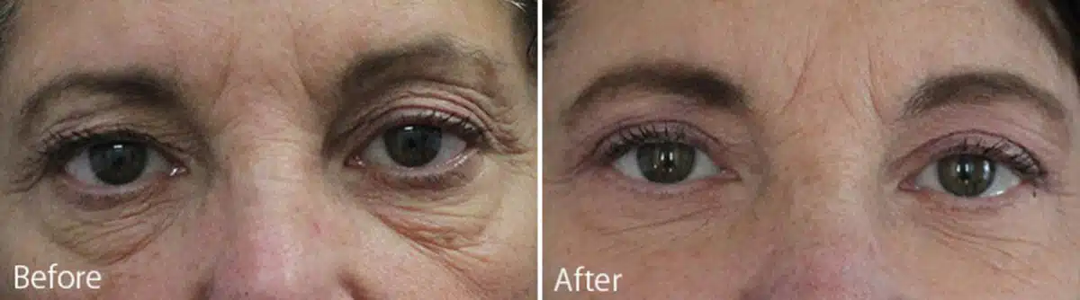 Upper and Lower Eyelid Surgery Before and After Photos in Princeton, NJ, Patient 907