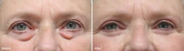 Upper and Lower Eyelid Surgery Before and After Photos in Princeton, NJ, Patient 956