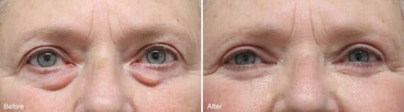 Upper and Lower Eyelid Surgery Before and After Photos in Princeton, NJ, Patient 956