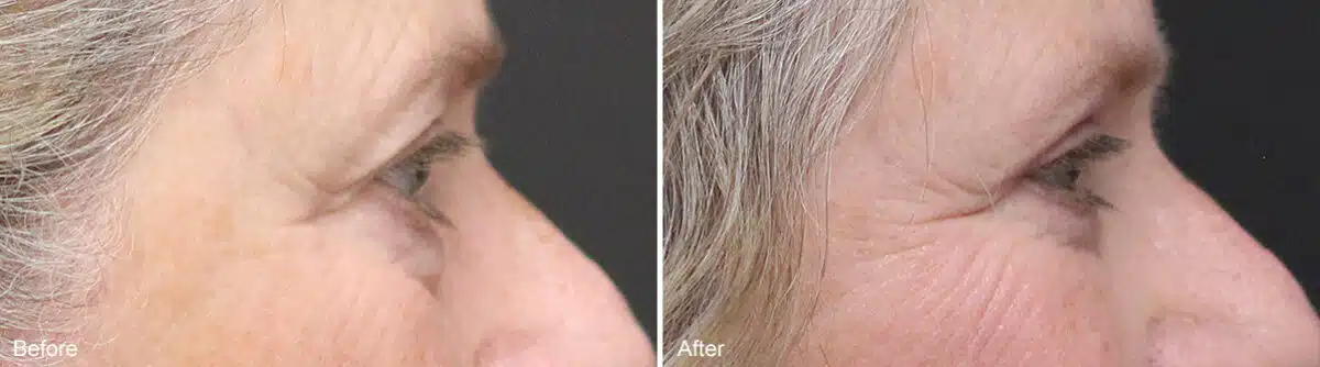 Upper and Lower Eyelid Surgery Before and After Photos in Princeton, NJ, Patient 956