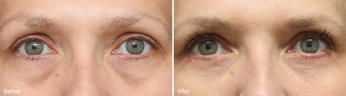 Upper and Lower Eyelid Surgery Before and After Photos in Princeton, NJ, Patient 963