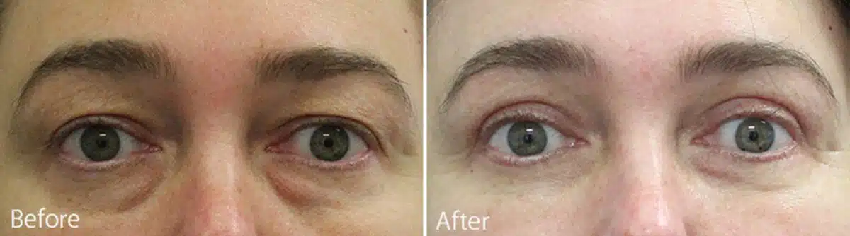 Upper and Lower Eyelid Surgery Before and After Photos in Princeton, NJ, Patient 915