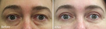 Upper and Lower Eyelid Surgery Before and After Photos in Princeton, NJ, Patient 915