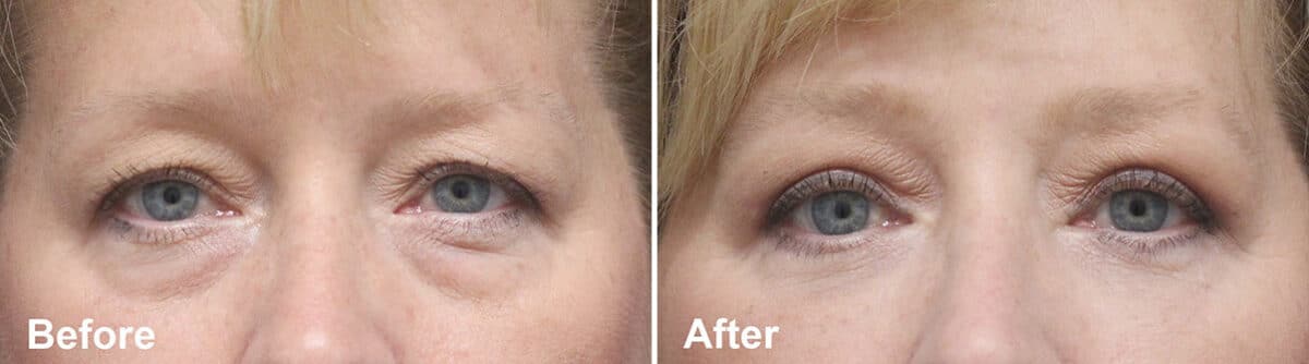 Upper and Lower Eyelid Surgery Before and After Photos in Princeton, NJ, Patient 919