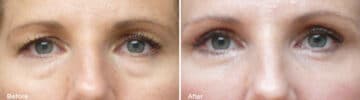 Upper and Lower Eyelid Surgery Before and After Photos in , , Patient 923