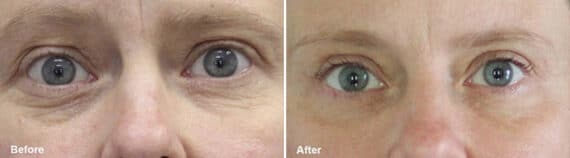 Upper and Lower Eyelid Surgery Before and After Photos in Princeton, NJ, Patient 927