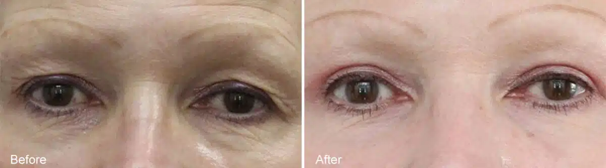 Patient 931, Upper and Lower Eyelid Surgery Before and After Photos Upper and Lower Eyelid Surgery Before and After Photos in Princeton, NJ, Patient 931