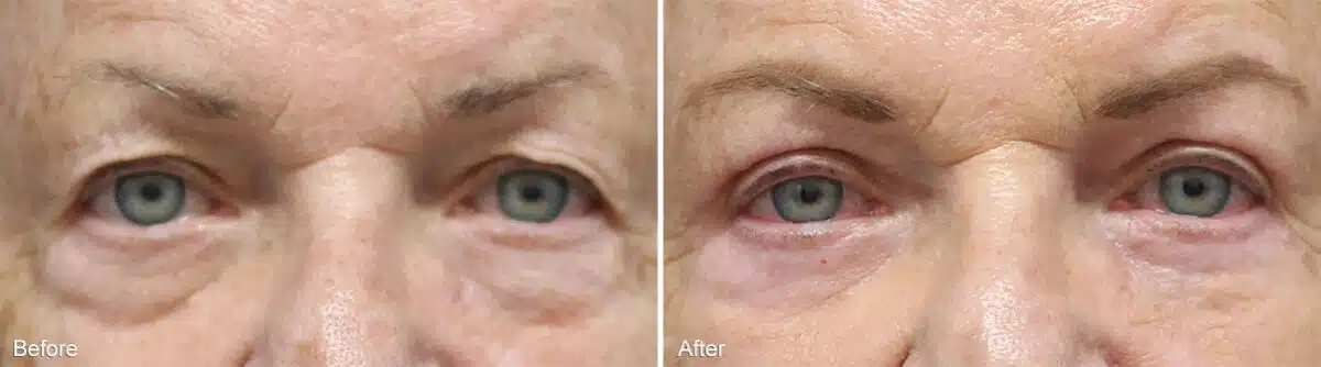 Upper and Lower Eyelid Surgery Before and After Photos in Princeton, NJ, Patient 935