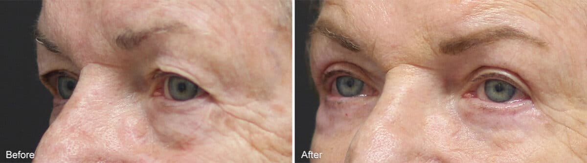 Upper and Lower Eyelid Surgery Before and After Photos in Princeton, NJ, Patient 935