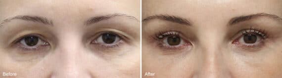 Upper Eyelid Surgery Before and After Photos in Princeton, NJ, Patient 977