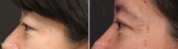 Upper Eyelid Surgery Before and After Photos in Princeton, NJ, Patient 1009