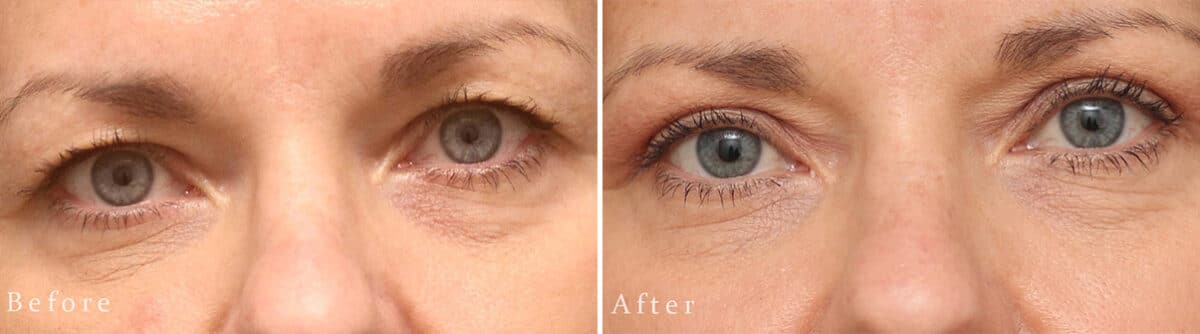 Upper Eyelid Surgery Before and After Photos in Princeton, NJ, Patient 1017