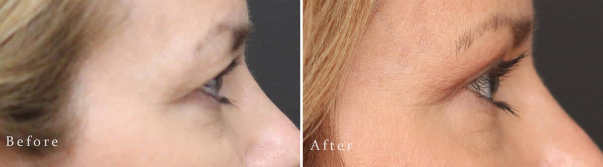 Upper Eyelid Surgery Before and After Photos in Princeton, NJ, Patient 1017