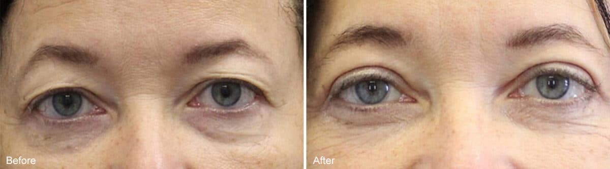 Upper Eyelid Surgery Before and After Photos in Princeton, NJ, Patient 973