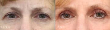 Upper Eyelid Surgery Before and After Photos in Princeton, NJ, Patient 1024