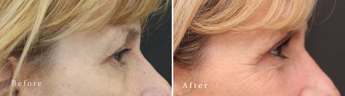 Upper Eyelid Surgery Before and After Photos in Princeton, NJ, Patient 1024