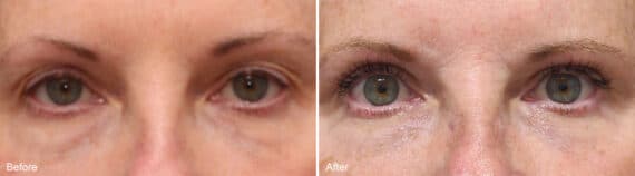 Upper Eyelid Surgery Before and After Photos in Princeton, NJ, Patient 1041